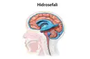Normal Basınçlı Hidrosefali Normal Basınçlı Hidrosefali