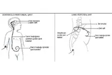 Hidrosefali Şant Özellikleri ve Faydaları Nelerdir? Hidrosefali Şant Özellikleri ve Faydaları Nelerdir?