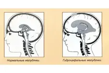 Yetişkinlerde Hidrosefali Belirtileri ve Tedavisi Yetişkinlerde Hidrosefali Belirtileri ve Tedavisi